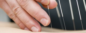 A form of acupuncture